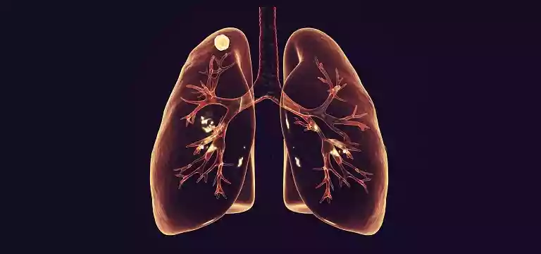  Secondary Tuberculosis Infection: Causes, Symptoms, Diagnosis, and Treatment